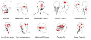Referral Patterns for neck muscles causing headaches