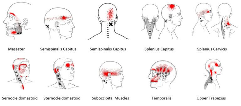 trigger-point-referral-patterns-headaches-maynard-acupuncture