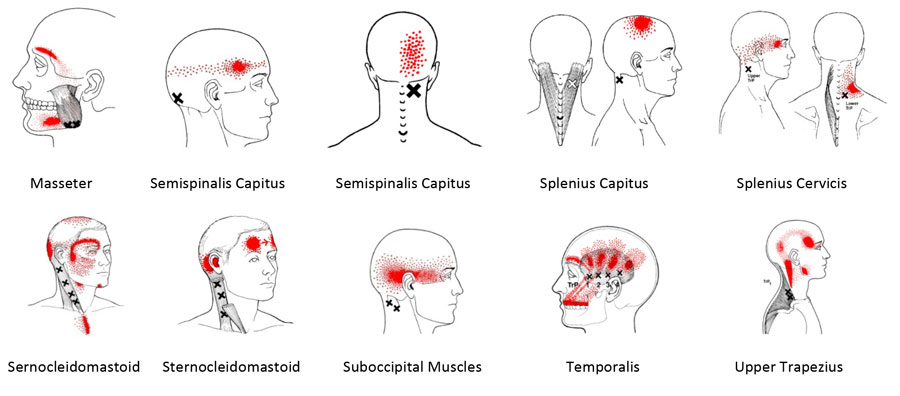 Referral Patterns for neck muscles causing headaches